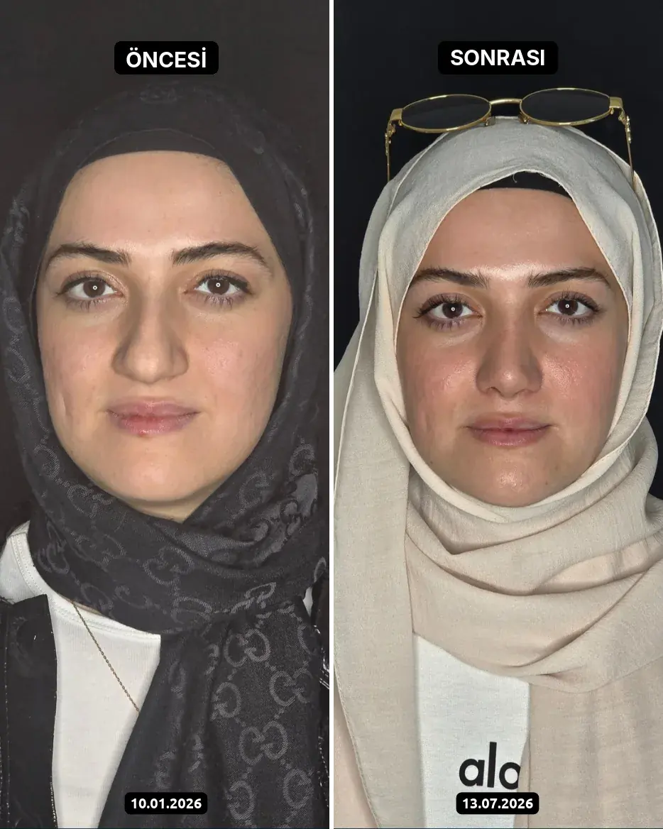 Öncesi – Sonrası, Burun estetiği · Fotoğraf tarihleri: 10.01.2026 ve 13.07.2026