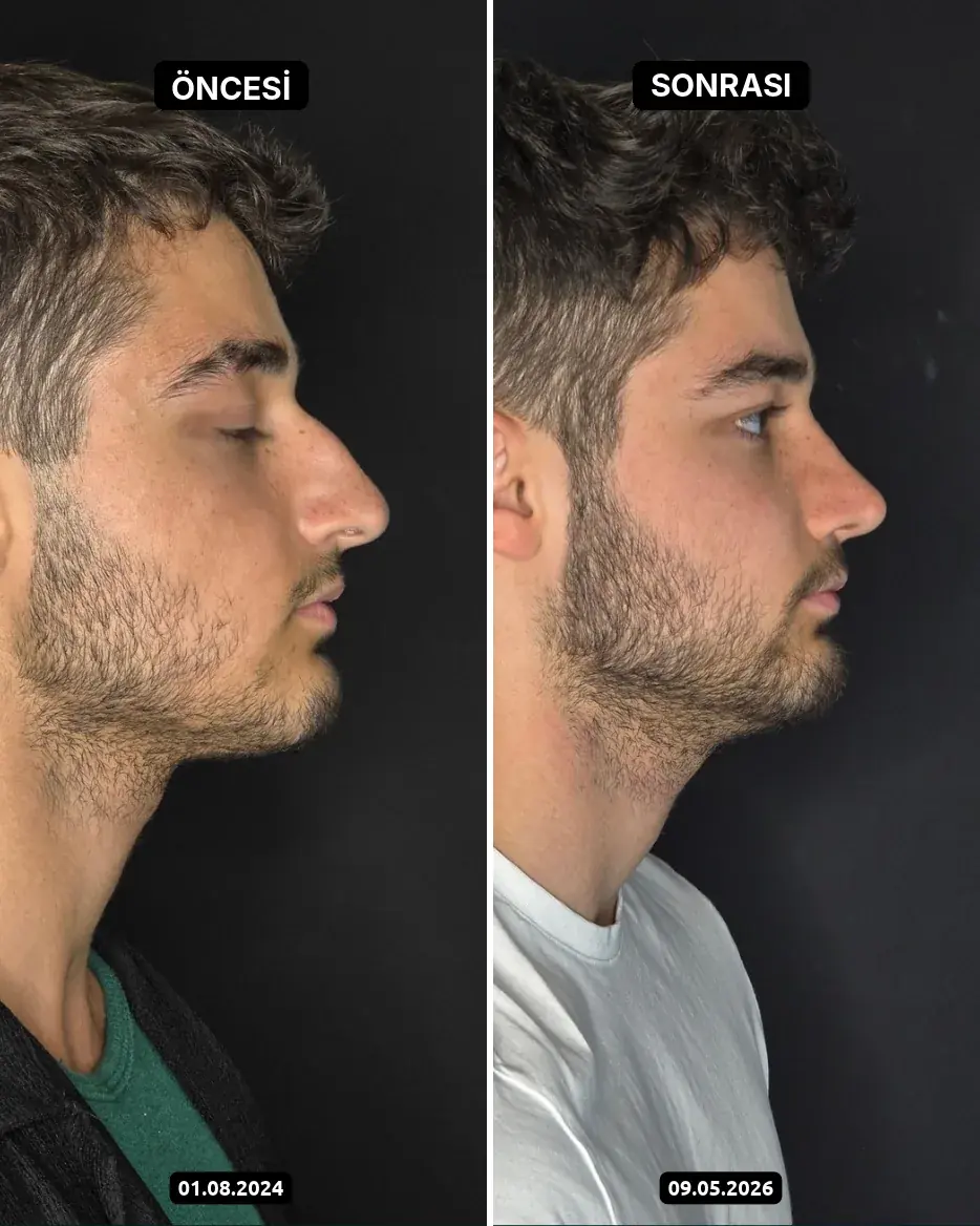 Öncesi – Sonrası, Burun estetiği · Fotoğraf tarihleri: 01.08.2024 ve 09.05.2026