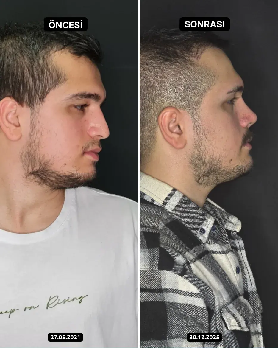 Öncesi – Sonrası, Burun estetiği · Fotoğraf tarihleri: 27.05.2021 ve 30.12.2025