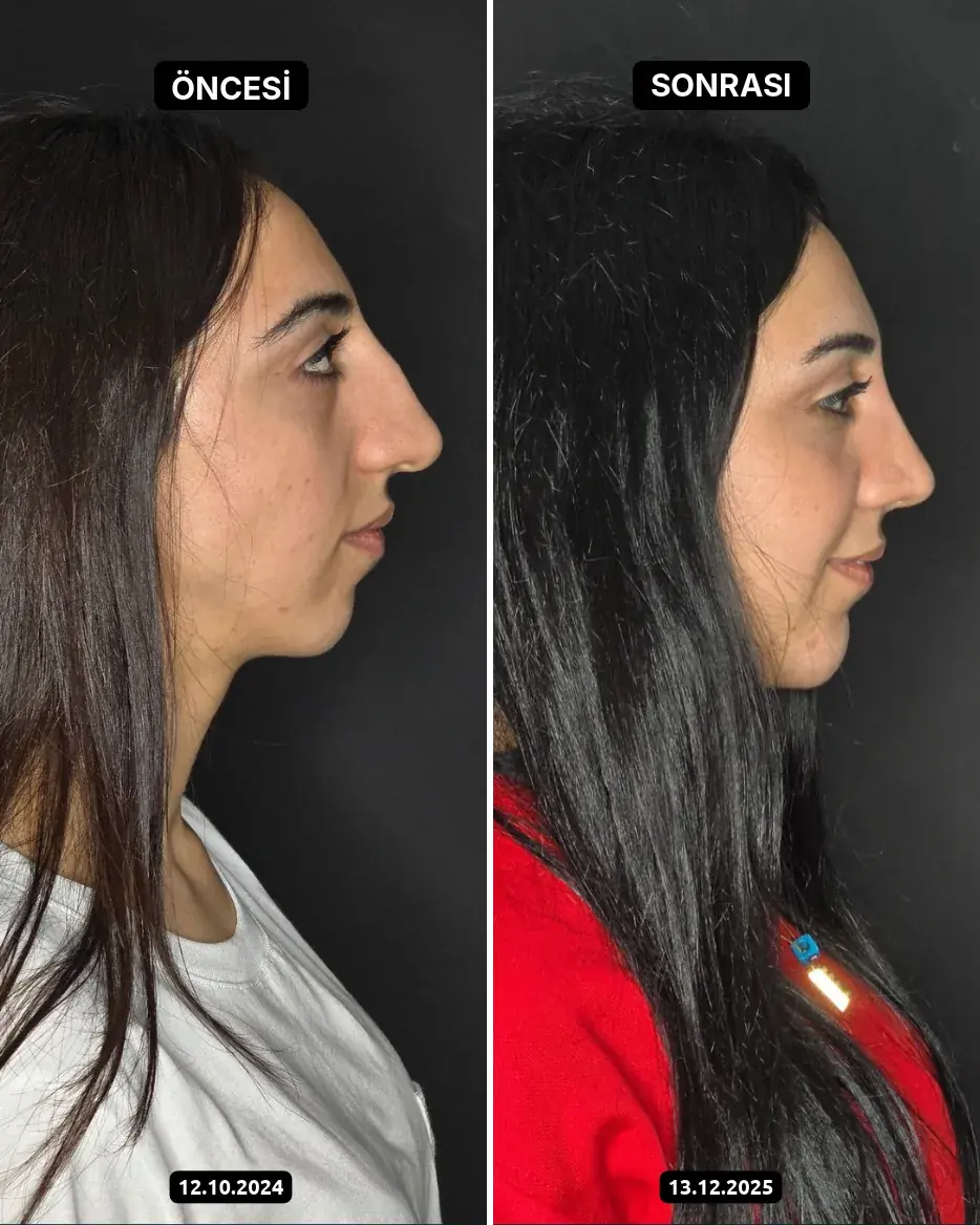 Öncesi – Sonrası, Burun estetiği · Fotoğraf tarihleri: 12.10.2024 ve 13.12.2025