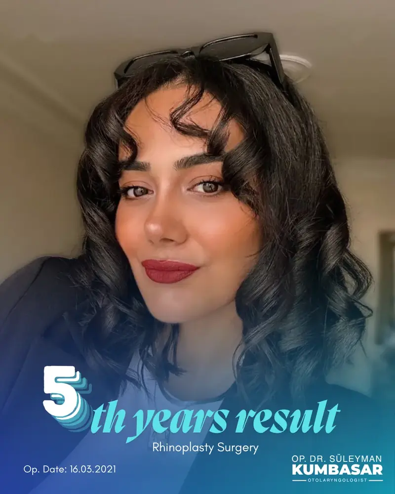 5 yıllık sonuç, Burun estetiği · Ameliyat: 16.03.2021