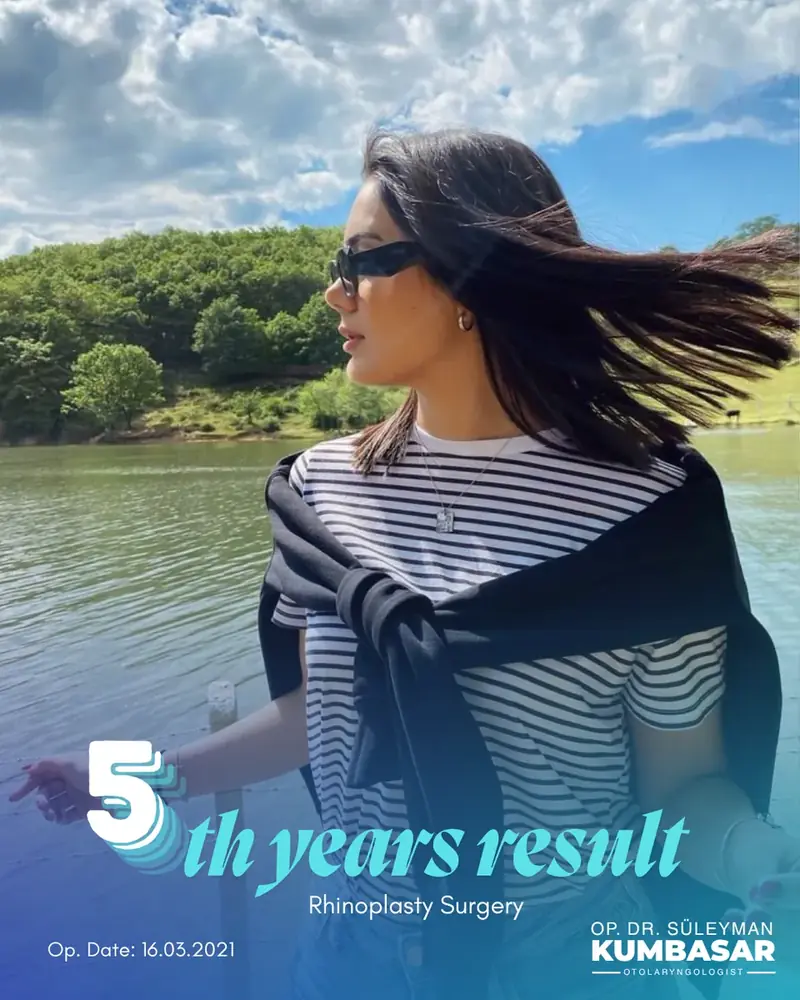 5 yıllık sonuç, Burun estetiği · Ameliyat: 16.03.2021