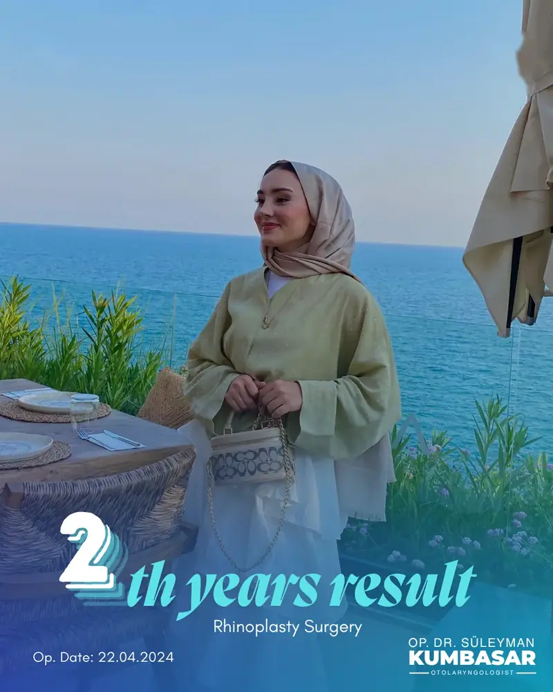 2 yıllık sonuç, Burun estetiği · Ameliyat: 22.04.2024