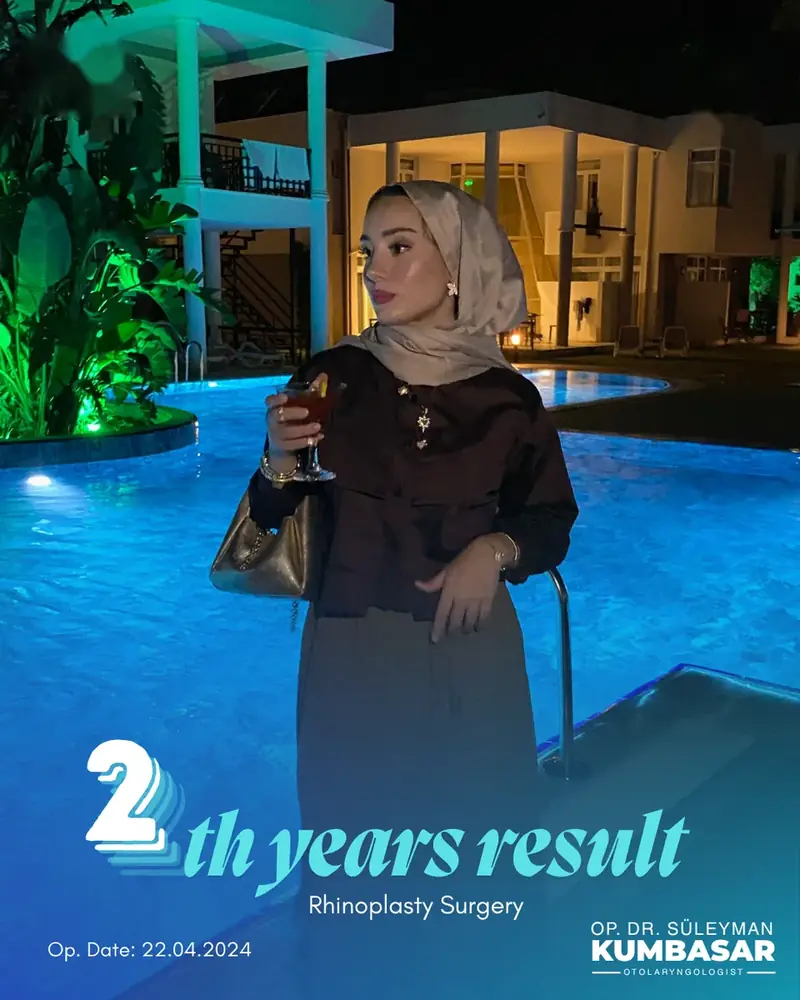 2 yıllık sonuç, Burun estetiği · Ameliyat: 22.04.2024