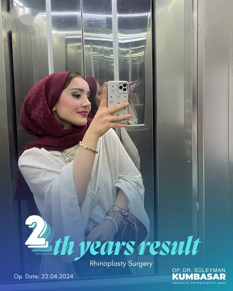 2 yıllık sonuç, Burun estetiği · Ameliyat: 22.04.2024