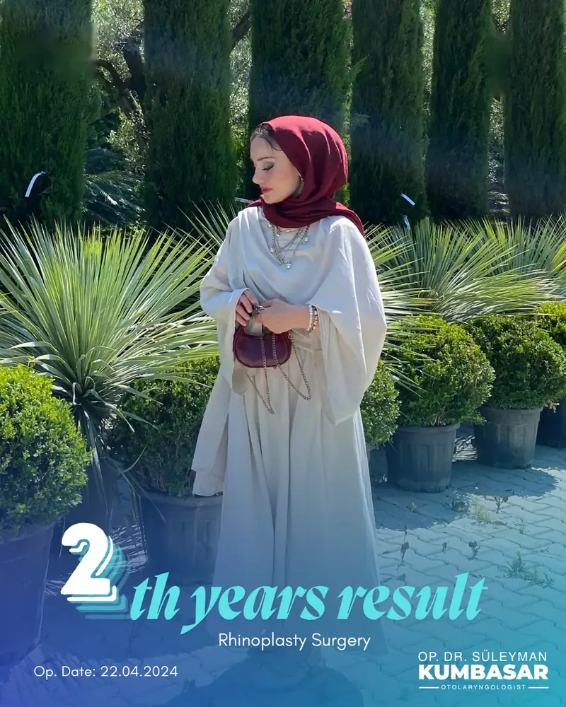 2 yıllık sonuç, Burun estetiği · Ameliyat: 22.04.2024