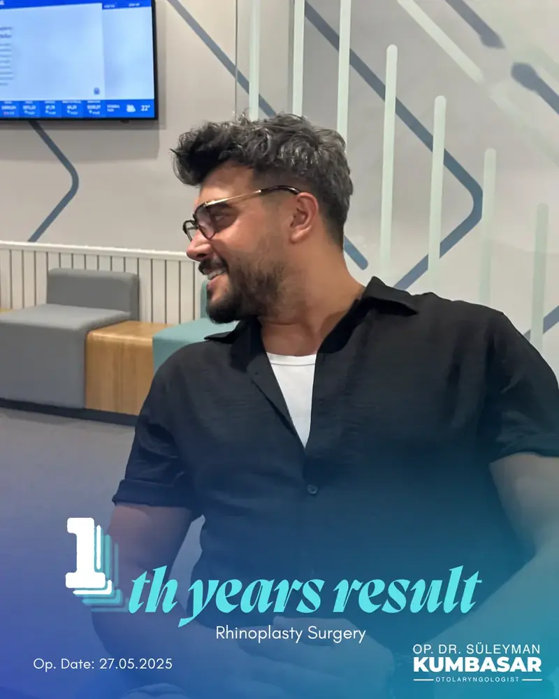 1 yıllık sonuç, Burun estetiği · Ameliyat: 27.05.2025
