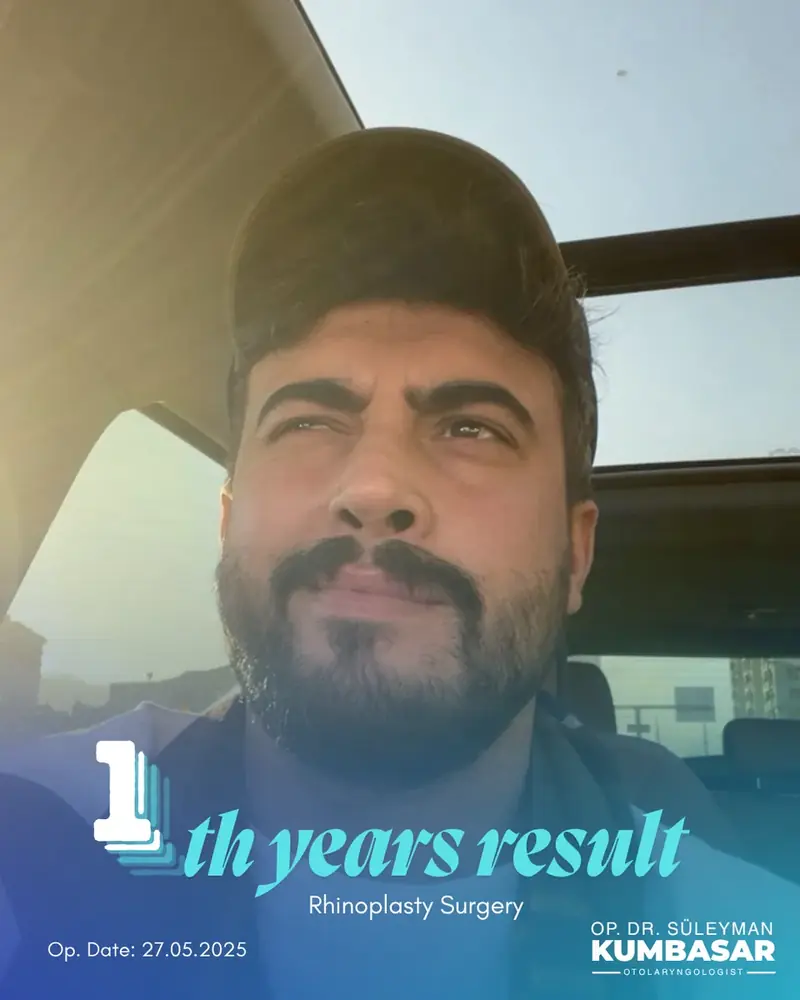 1 yıllık sonuç, Burun estetiği · Ameliyat: 27.05.2025