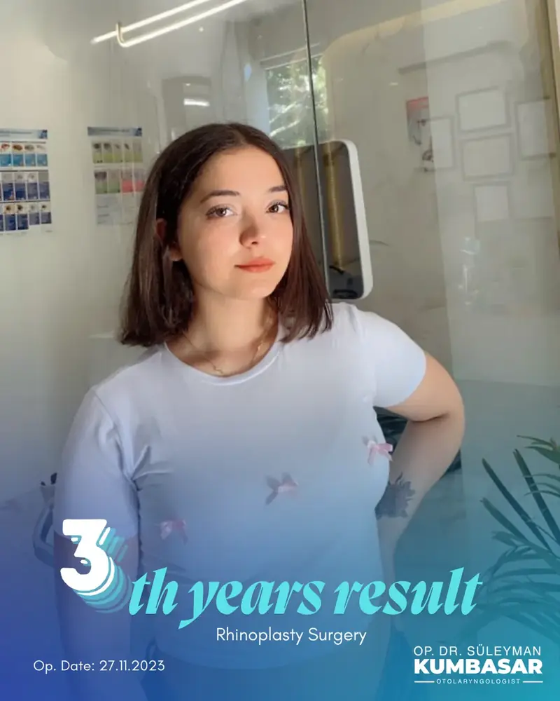 3 yıllık sonuç, Burun estetiği · Ameliyat: 27.11.2023