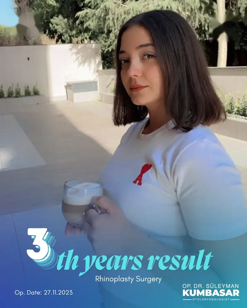 3 yıllık sonuç, Burun estetiği · Ameliyat: 27.11.2023