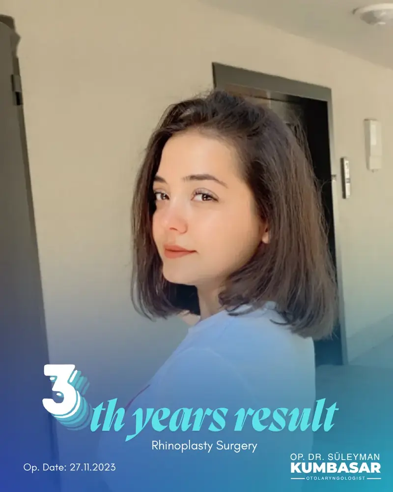 3 yıllık sonuç, Burun estetiği · Ameliyat: 27.11.2023
