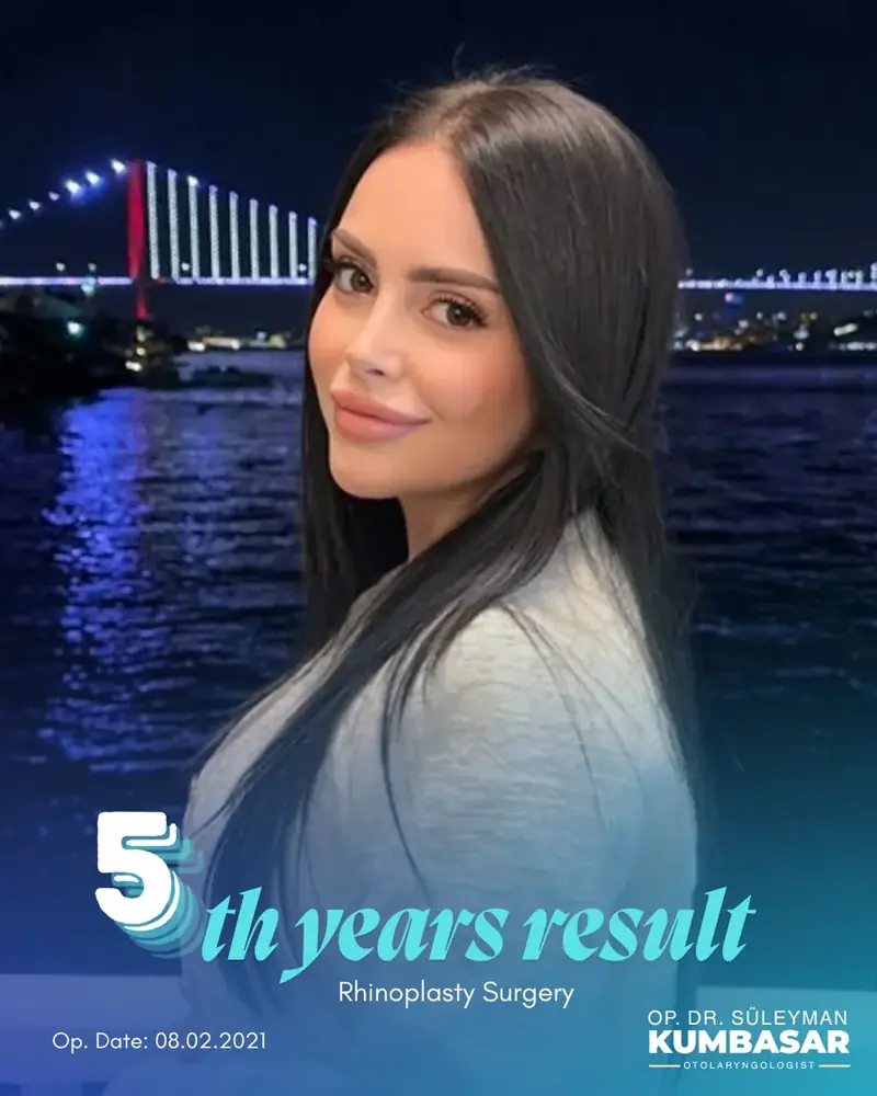 5 yıllık sonuç, Burun estetiği · Ameliyat: 08.02.2021