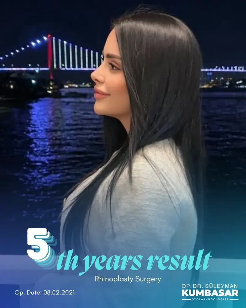 5 yıllık sonuç, Burun estetiği · Ameliyat: 08.02.2021