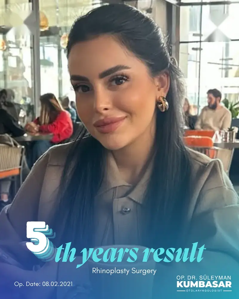 5 yıllık sonuç, Burun estetiği · Ameliyat: 08.02.2021